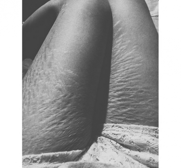 In 2008 I was 18 and diagnosed with lupus and had kidney failure I was retaining liquid so I got swollen and lost a lot of weight. It's been 6 years with stretch marks. I'm 23 years old now with 2 kids and trying to beat lupus. I love wearing shorts and skirts but when I go out everybody is looking at my legs like its disgusting. I tell my husband that sometimes I feel ashamed of my stretch marks but he tells me I don't care that you have stretch marks.