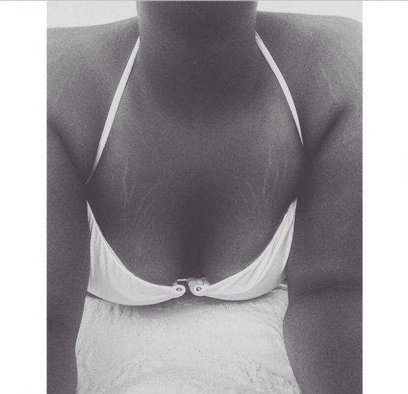 If you could name any place on my body, I have stretch marks there. I'm only 22, no kids, no nothing. I've had my stretch marks since I was 12 & I used to get teased throughout middle & high school. I used to be so self conscious. I wouldn't buy shirts unless they had sleeves & covered my entire body. I even battled with bulimia for a few years because I wanted to be skinny & beautiful. As I've gotten older, I've accepted that my stretch marks aren't going anywhere, so there's no point in trying to hide them. I'm still beautiful & my boyfriend loves to run his fingers up & down my tiger stripes. I'm a warrior against this weight battle, but I will always come out on top & I will always be beautiful."