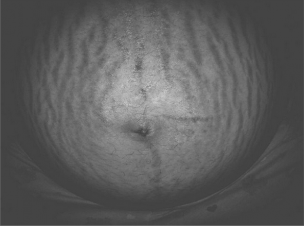 "I am 36 weeks pregnant with a baby boy. I started getting stretch marks as soon as I found out I was pregnant. It didn't take long until my whole stomach was covered in what seemed to be a million lines. I see so many beautiful tummies all over social media, tv, and etc. and get discouraged sometimes about my stomach! But I have came to realization that these "lines" on my stomach represent something even greater that I can even comprehend at times. I have been given a precious gift by God and am housing a beautiful child. Each mark shows his growth, and how could I be ashamed of that?"