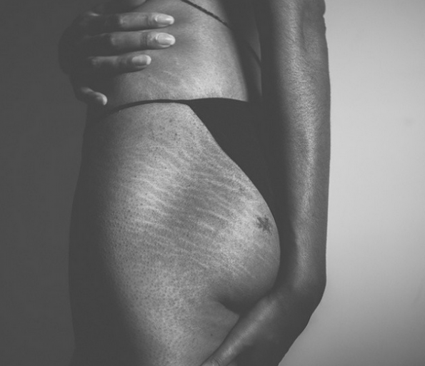 This 31 year young woman has learned to not care so much about her tiger stripes although it wasn't easy. They are apart of who she is. She had them even before having babies. Mom of 2. #loveyourlines