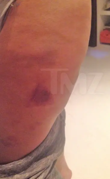 joe-budden-injury-photos-09-480w