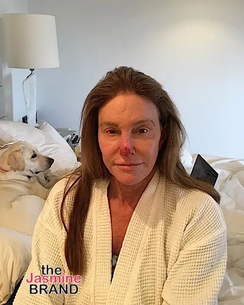 Caitlyn Jenner Posts Graphic Photo After Having Skin Cancer Cut From Her Nose