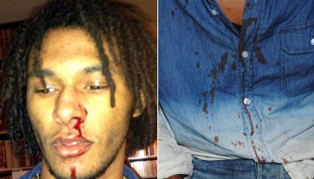 Ouch! Court Releases Bloody Chris Brown Bodyguard Assault Photos