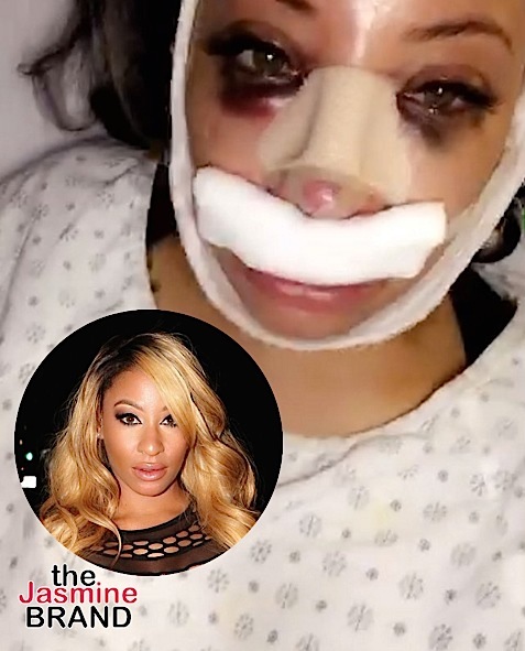 Ouch! Reality Star Hazel E Gets A Nose Job [VIDEO]