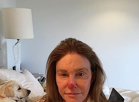 Caitlyn Jenner Posts Graphic Photo After Having Skin Cancer Cut From Her Nose