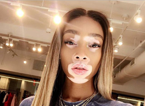 Winnie Harlow – “America’s Next Top Model” Really Didn’t Do Anything For My Career