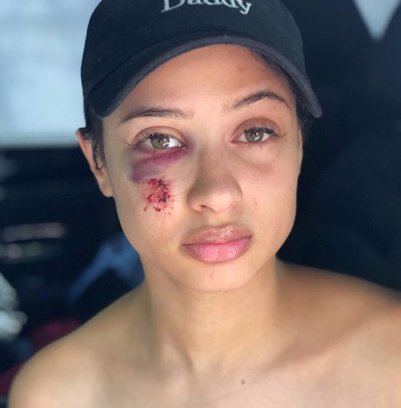 Tori Brixx Shows Of Her Bloodied Face After Being Pistol Whipped w/ BF Rich The Kid, Argues w/ Rapper’s Estranged Wife