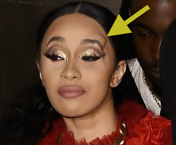 Nicki Minaj’s Security Elbowed Cardi B In The Head, Causing Disfigured Lump [Photos]