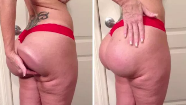Butt Implants Linked To Deadly Cancer, According To New Study 
