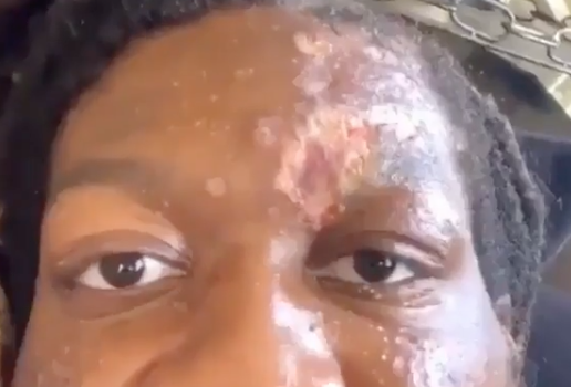 Rapper OG Maco Says Friends Have Disappeared Amid Skin-Eating Disease Diagnosis [VIDEO]