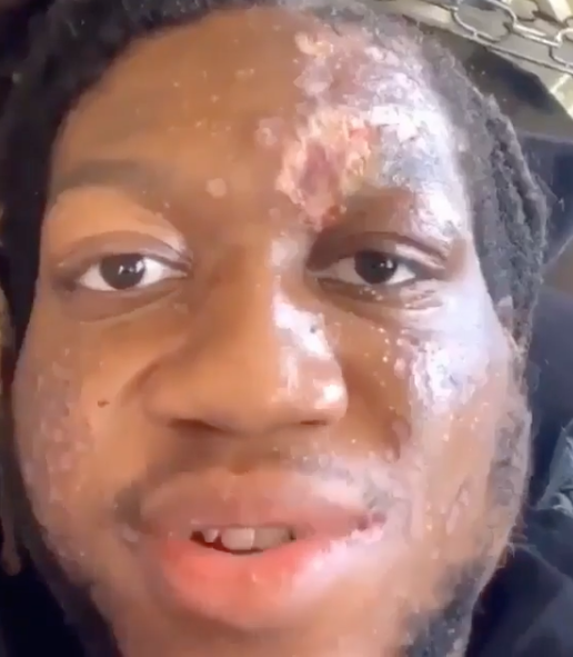 Rapper OG Maco Says Friends Have Disappeared Amid Skin-Eating Disease Diagnosis [VIDEO]