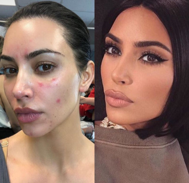 Kim Kardashian Opens Up About Struggling With Psoriasis Flare-Ups & Psoriatic Arthritis