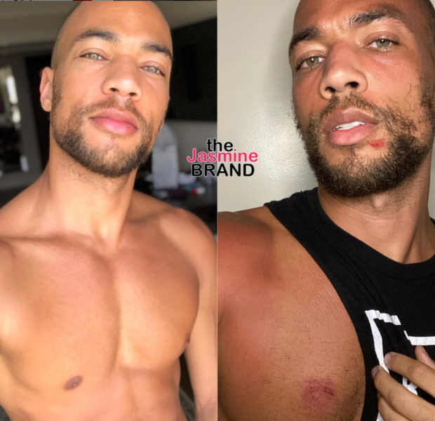 ‘Insecure’ Actor Kendrick Sampson Shows His Bruises After Being Shot w/ Rubber Bullets During Protests in L.A.