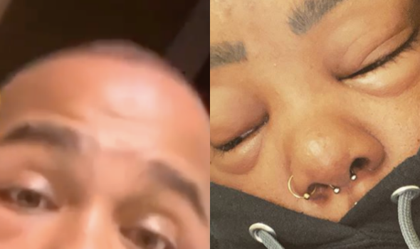 Yung Berg Shows His Face After Appearing To Suffer Severe Allergic Reaction, Rapper Tokyo Vanity Goes To ER With A Similar Case