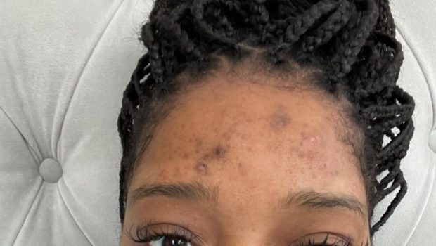 Keke Palmer Opens Up About Her Struggles With Acne & PCOS [Photos]