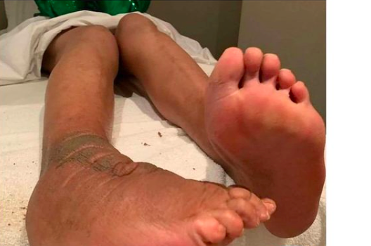 Wendy Williams Shares Rare Photo Of Chronic Foot Condition, Later Deletes