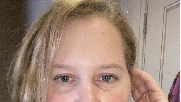 Amy Schumer Reveals She Suffers From Trichotillomania, A Condition That Causes Her To Compulsively Pull Out Her Hair