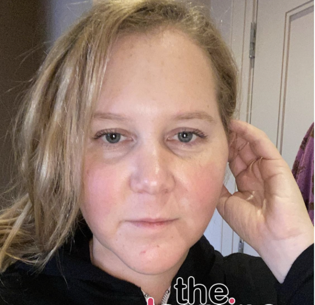 Amy Schumer Reveals She Suffers From Trichotillomania, A Condition That Causes Her To Compulsively Pull Out Her Hair