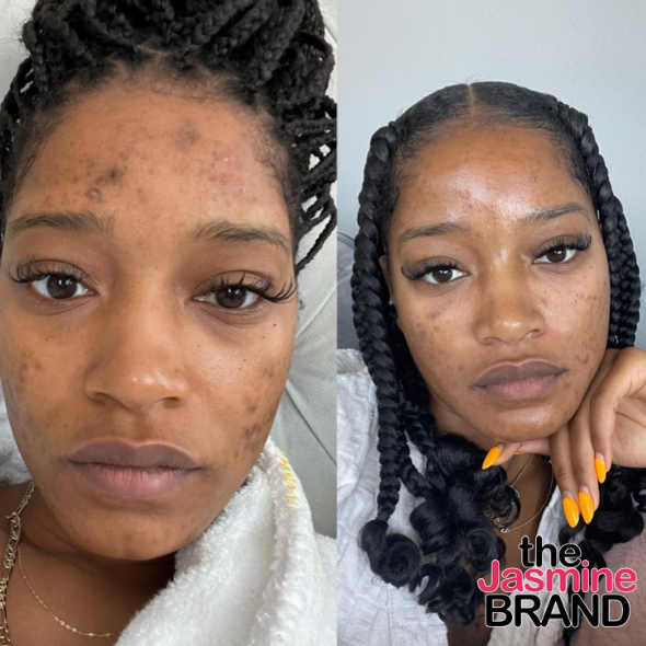 Keke Palmer Opened Up About Her Adult Acne and PCOS Diagnosis