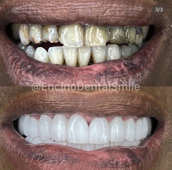 nicki minaj teeth before and after