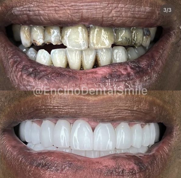 rappers teeth before and after