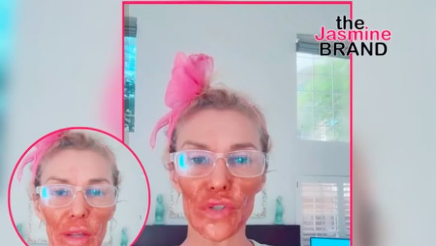 ‘RHOBH’ Alum Brandi Glanville Severely Burns Her Face After Using Nair In An Attempt To Kill Facial Parasite