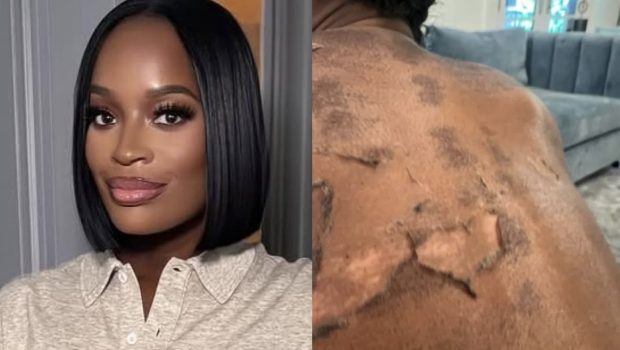 RHOA’s Shamea Morton Claims Chemical Peel Left Her Blistered and Permanently Scarred, Sues Doctor Boost