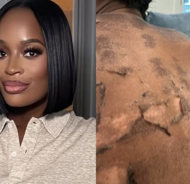 RHOA’s Shamea Morton Claims Chemical Peel Left Her Blistered and Permanently Scarred, Sues Doctor Boost