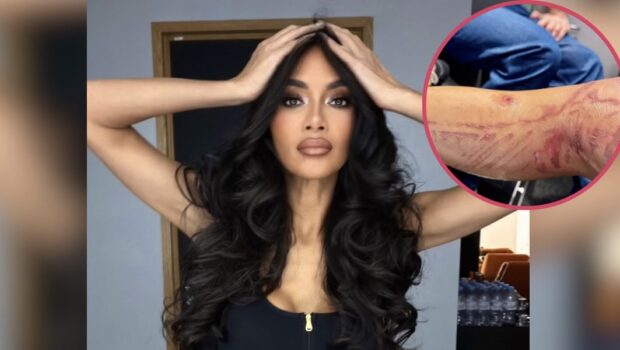 Prayers Up! Pussycat Dolls’ Nicole Scherzinger Shows Off Severe Burns After Boiling Water Spills On Her Leg Before Show