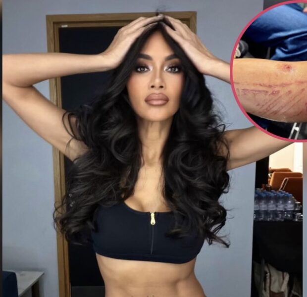 Prayers Up! Pussycat Dolls’ Nicole Scherzinger Shows Off Severe Burns After Boiling Water Spills On Her Leg Before Show